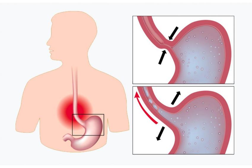 GORD, Gastro-oesophageal reflux disease