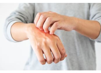 Hand scratching eczema